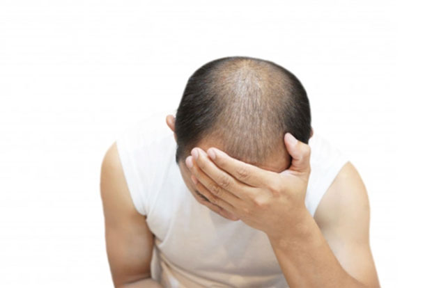 تاثیر اختلالات هورمونی بر ریزش مو