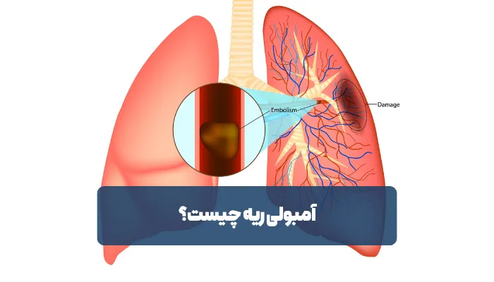 علت‌ بوجود آمدن آمبولی ریه