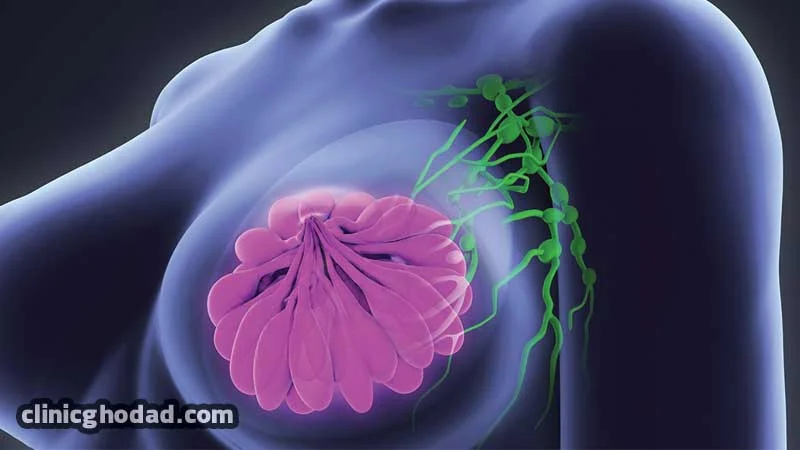 تفاوت کیست سینه با تومور