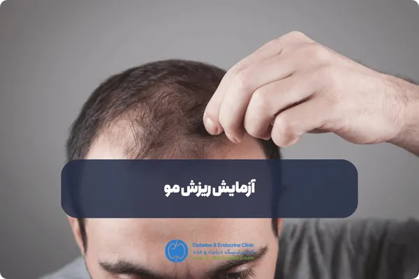 آزمایش ریزش مو